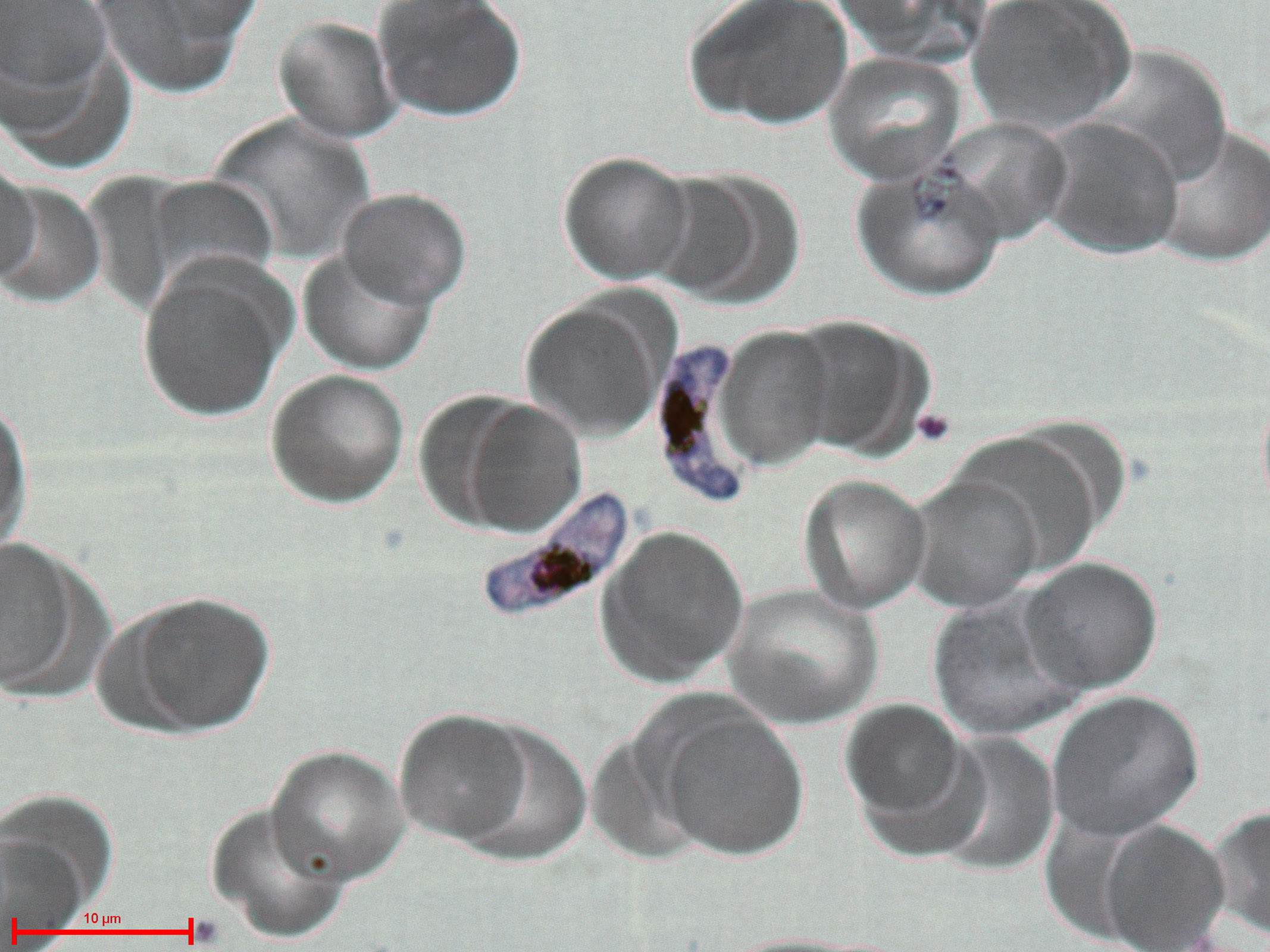 malária plazmodium parazita)