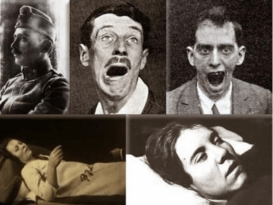 Летаргический энцефалит - загадочное неврологическое заболевание