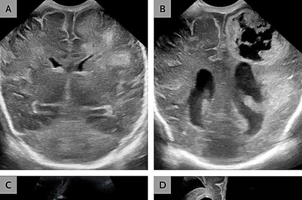 Случаи деструктивного менингита вызывают опасения по поводу появления нового патогена