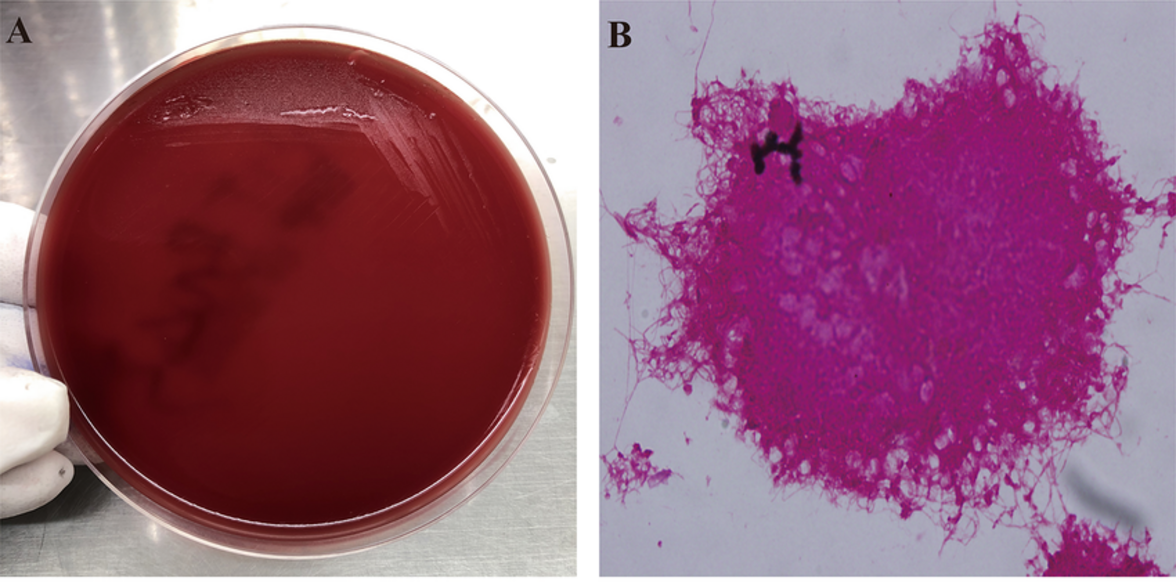 Как бактерии могут способствовать развитию рака молочных желез