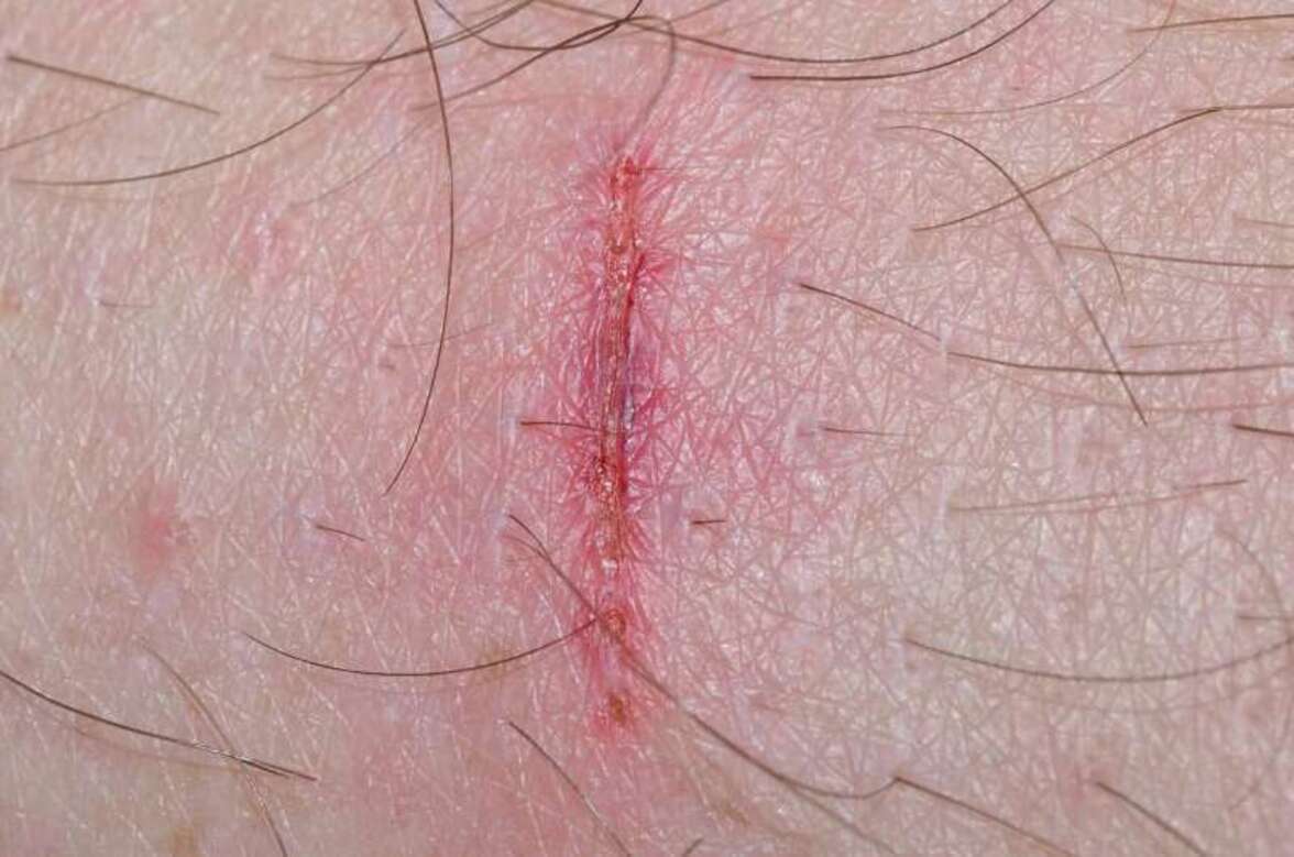 Умная раневая повязка доставляет антибиотики по требованию, ускоряя заживление и снижая резистентность