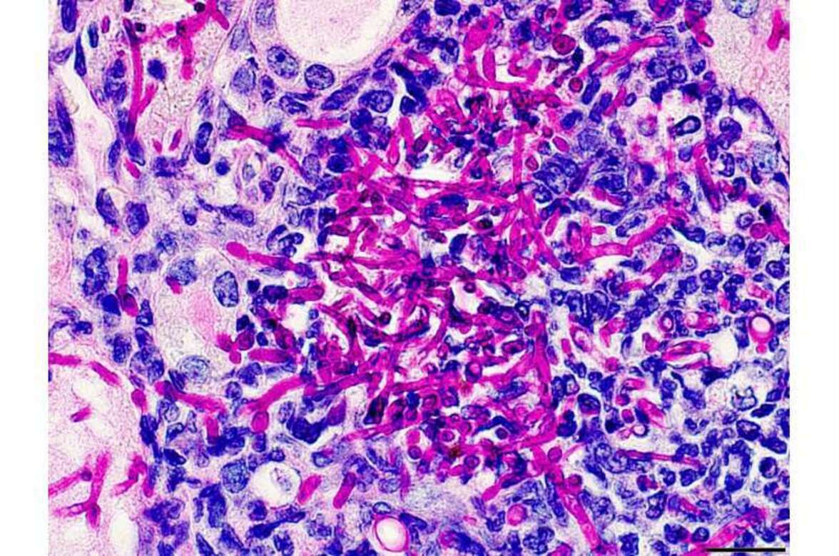 Исследование указывает на возможность перепрограммирования иммунной системы для лечения кандидоза