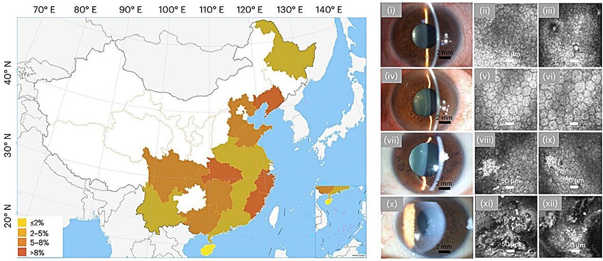 Вирус, содержащийся в морепродуктах, связан с хроническим заболеванием глаз у людей